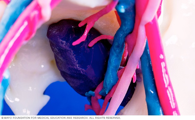 3D-printed models use color coding to help doctors identify tissue to be removed during surgery